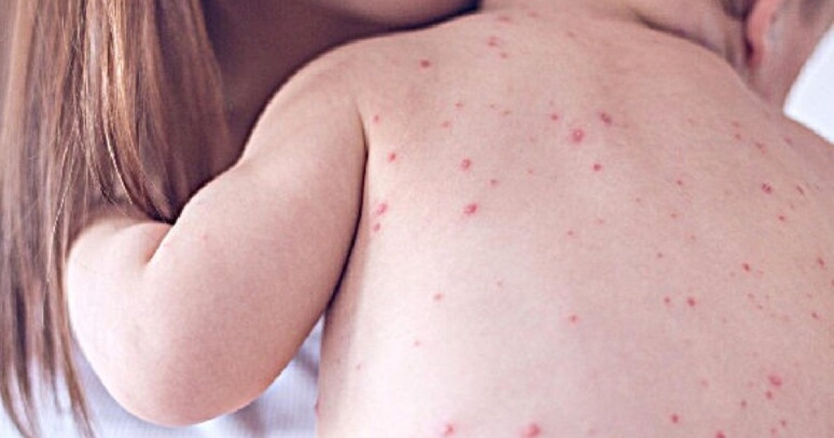 Calabria al centro dell’aumento del morbillo in Italia: contagi medi attorno ai 30 anni e pressioni ospedaliere